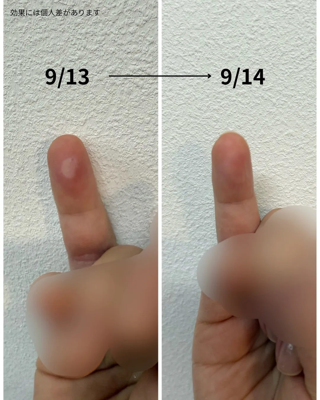 火傷に早めの対処でキレイになりました!